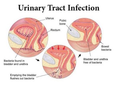 Urinary Tract Infections(UTIs)